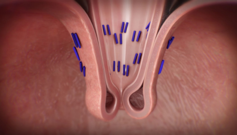 GERD surgery near me